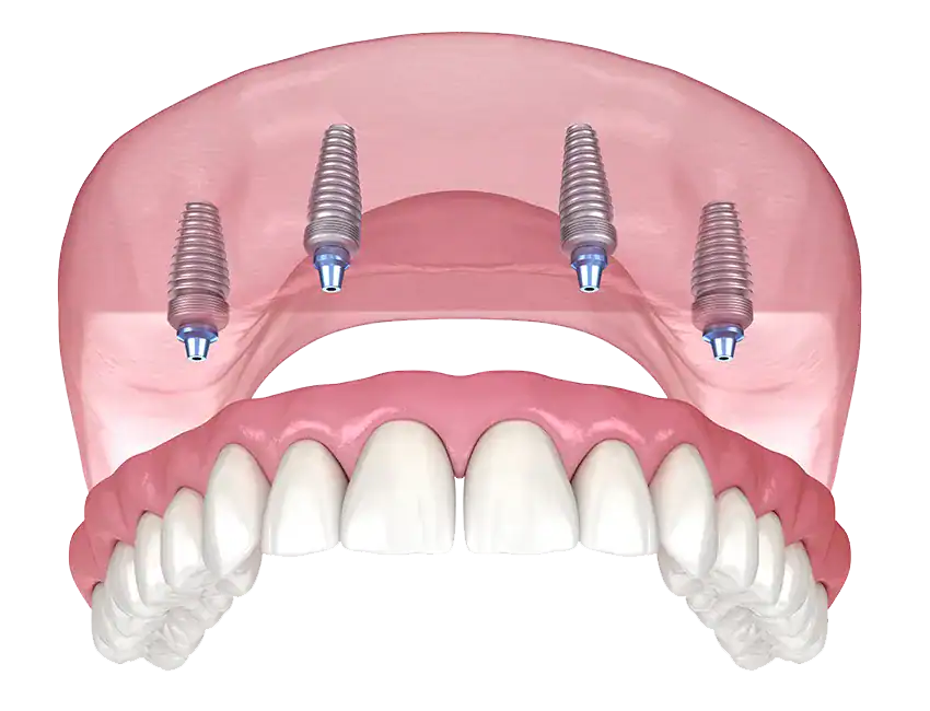 All-on-4 Dental Implants at The Smile Spa in Agoura Hills, CA — How Dentists Plan the All-on-4 Procedure