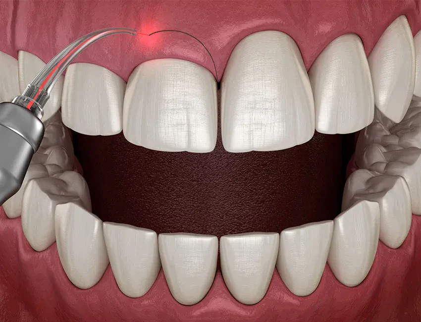 Gum Contouring at The Smile Spa