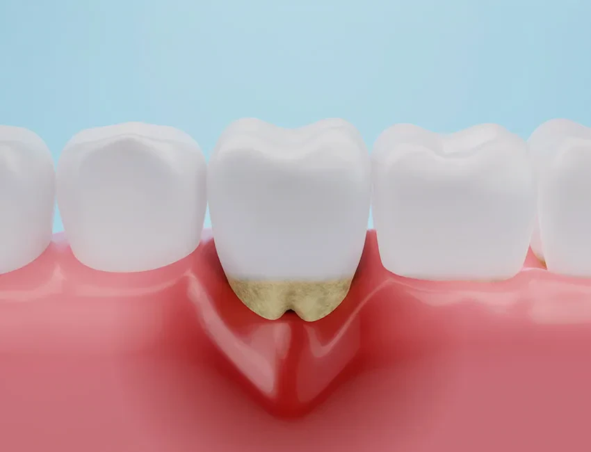 Periodontal Care at The Smile Spa
