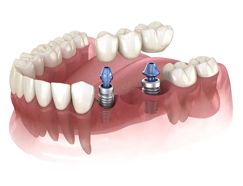 Multi-Tooth Implant Bridges