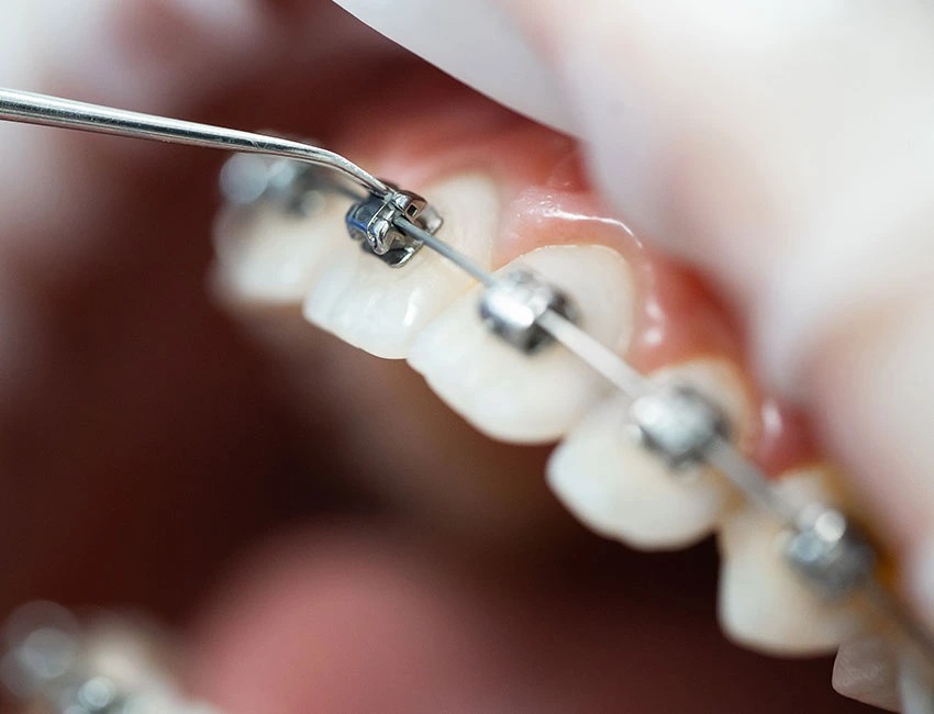 Orthodontic braces at The Smile Spa