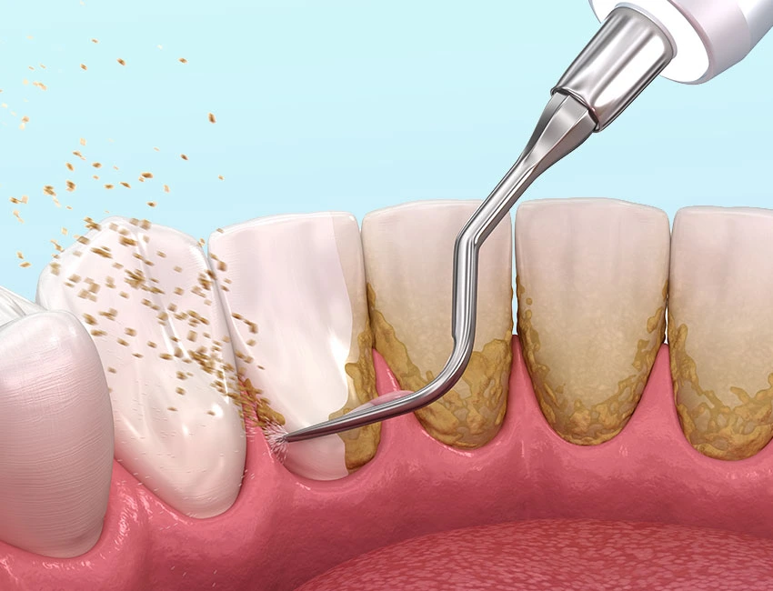 Oral Health at The Smile Spa in Agoura Hills, CA — Oral Hygiene Basics: Is Mouthwash Good For Your Teeth?