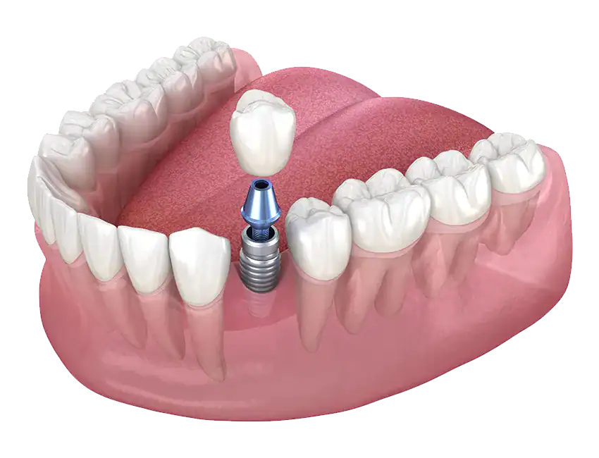 Single-Tooth Implant