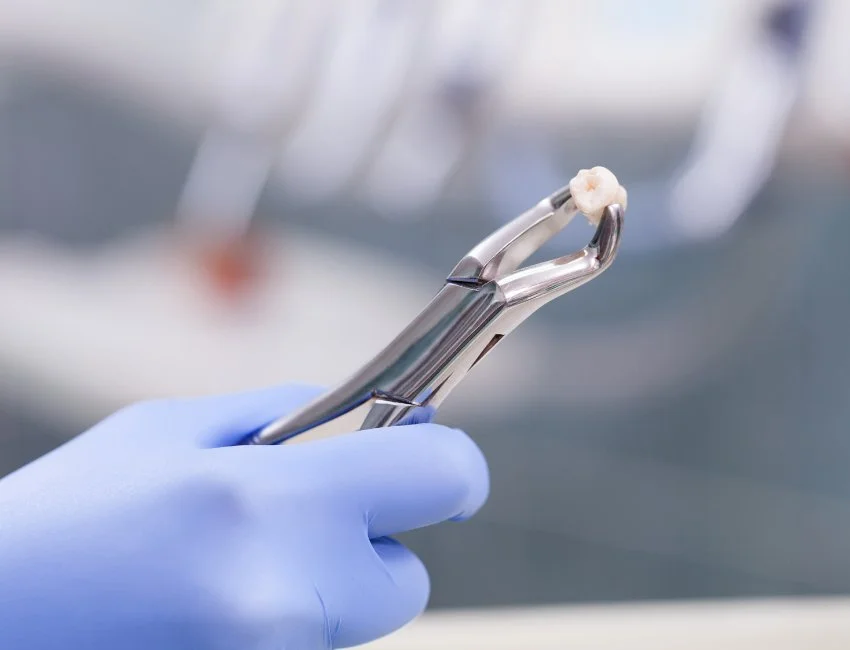 Tooth-Extraction-pain-less wisdom teeth