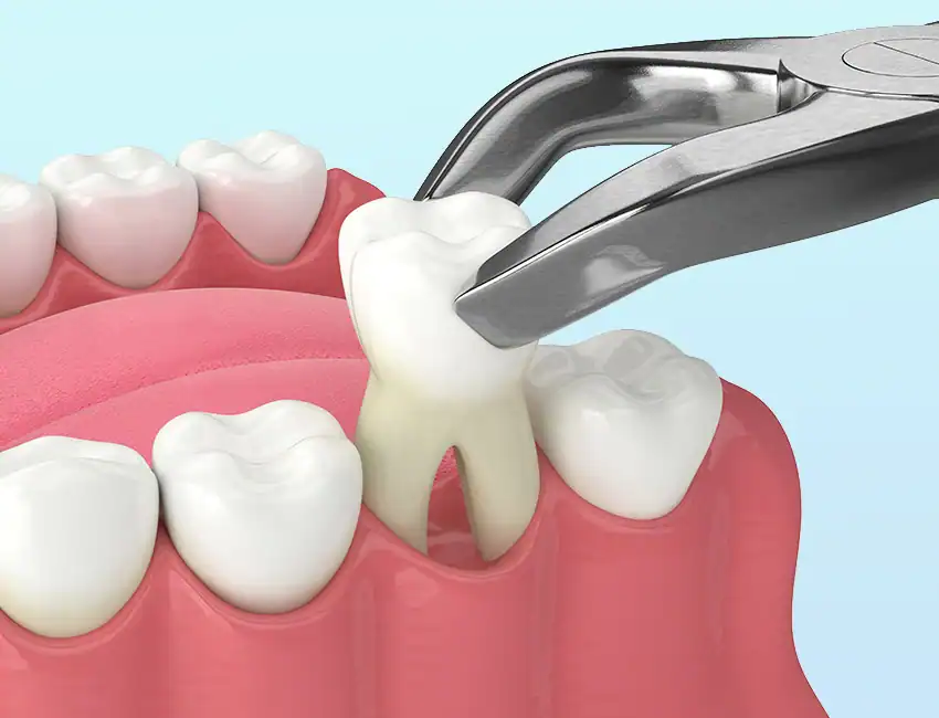 Oral Surgery at The Smile Spa in Agoura Hills, CA — Can I Still Get an Implant if My Jawbone Is Thin?