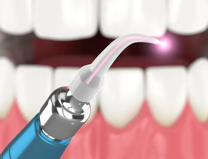 Laser Dentistry at The Smile Spa