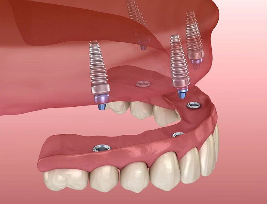All-on-4 implants restore your smile