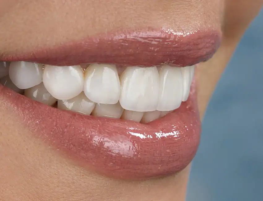 Dental Bonding at The Smile Spa