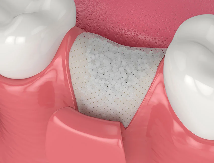 Bone Grafting