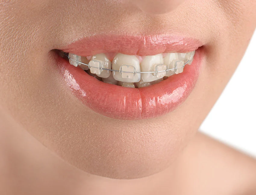 Happy patient with ceramic braces