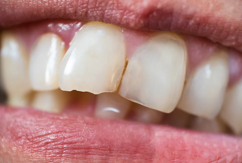 Chipped a Tooth? in Agoura Hills, CA