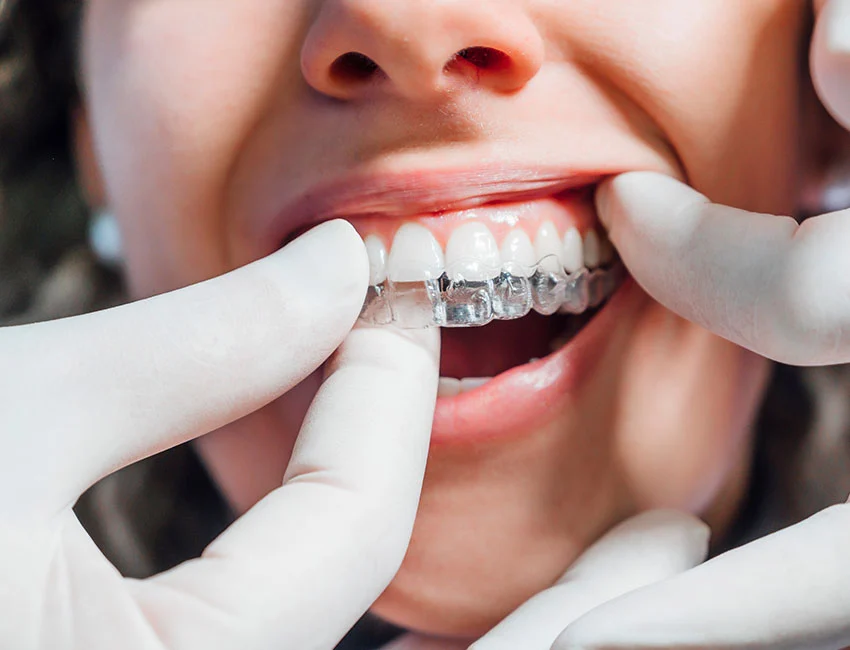 Invisalign at The Smile Spa in Agoura Hills, CA — Why Invisalign May Be Better for a Teen