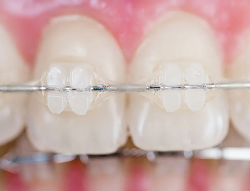 Multi-Tooth Implant Bridges