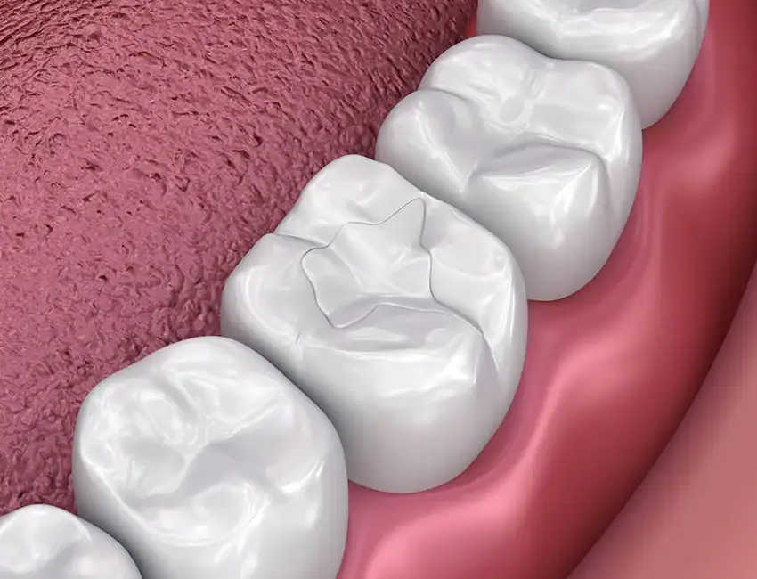 Dental Fillings at The Smile Spa