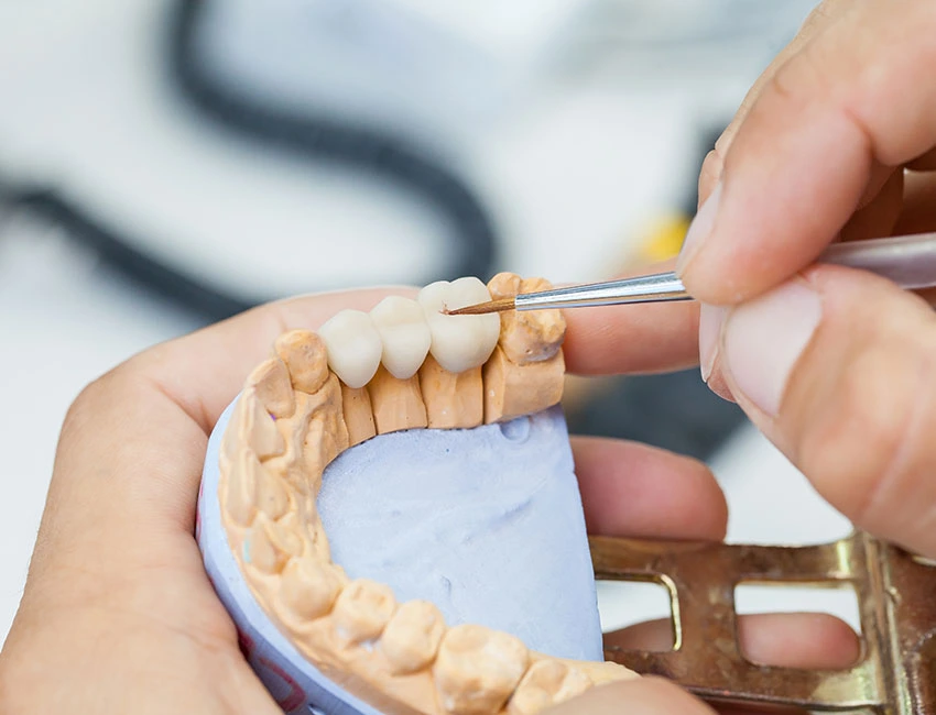 Dental Bridges at The Smile Spa