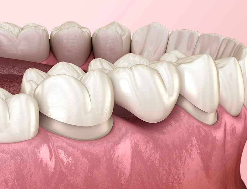 Dental Bridges at The Smile Spa in Agoura Hills, CA — When Is a Dental Bridge Necessary?