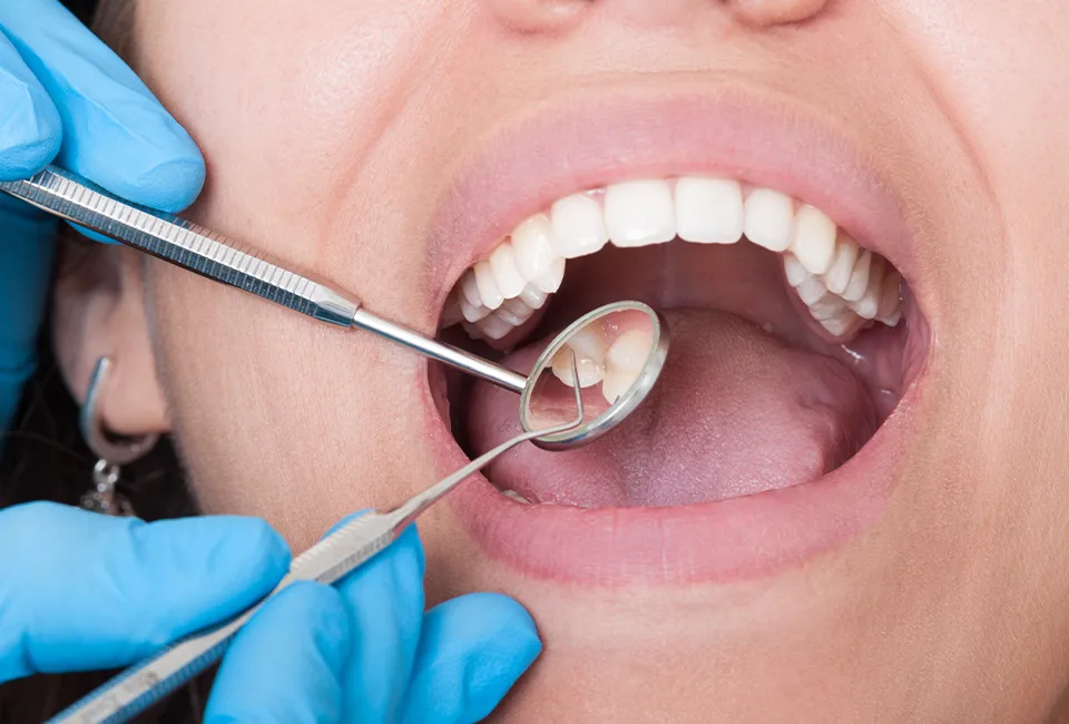 Fluoride Treatments in Agoura Hills, CA
