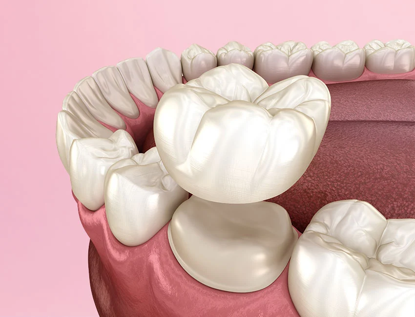 Restorative Dentistry at The Smile Spa in Agoura Hills, CA — Relieving Pain With Root Canal Therapy