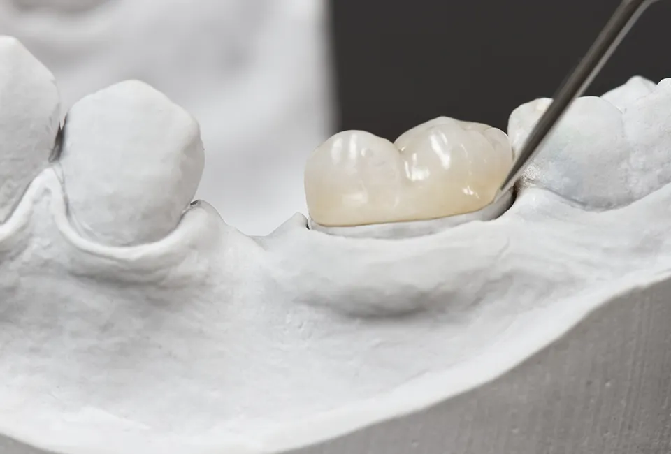 Dental Bridges at The Smile Spa in Agoura Hills, CA — Who Makes a Good Candidate for Dental Bridges?