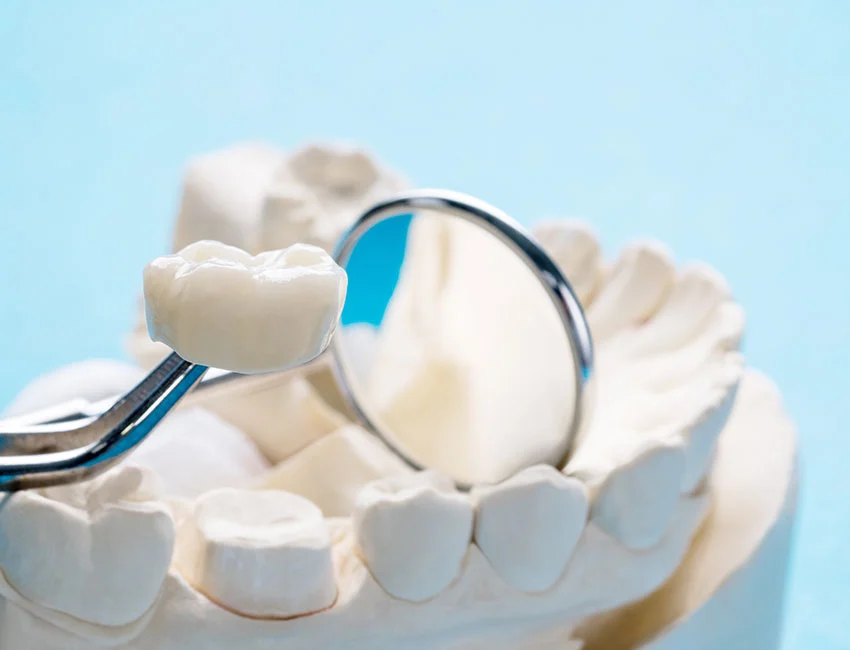 Dental Crowns and Dental Bridges at The Smile Spa in Agoura Hills, CA — Top 5 Habits That Help a New Crown Last in Agoura Hills, CA