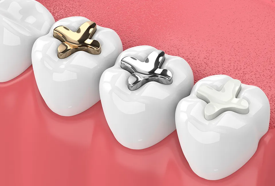 Composite Fillings at The Smile Spa in Agoura Hills, CA — Top 5 Signs It's Time to Replace an Old Filling