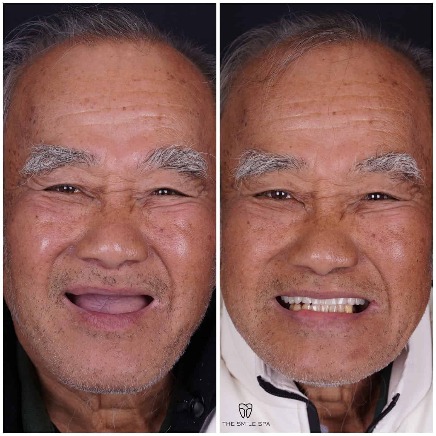Replacing Missing Teeth in Agoura Hills, CA
