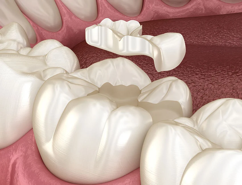 Inlays & Onlays at The Smile Spa
