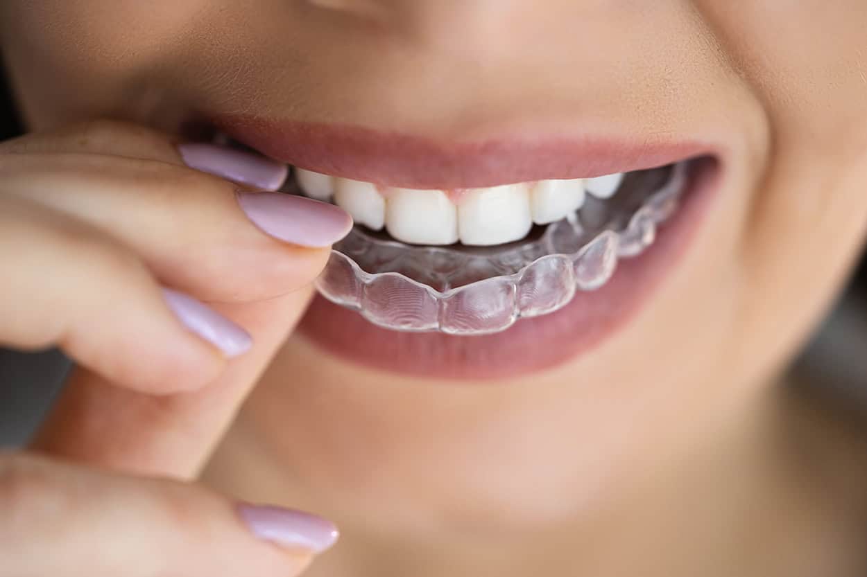 what to do when a dental filling falls out at home