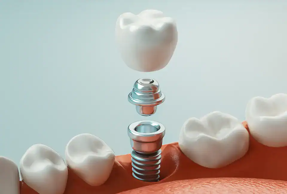 dentistry-images (4) (1) permanent dental implants