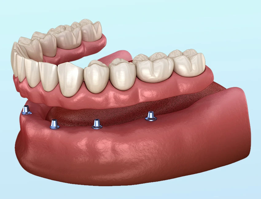 Implant Supported Dentures at The Smile Spa in Agoura Hills, CA — 3 Questions to Ask Your Dentist About Oral Hygiene Basics