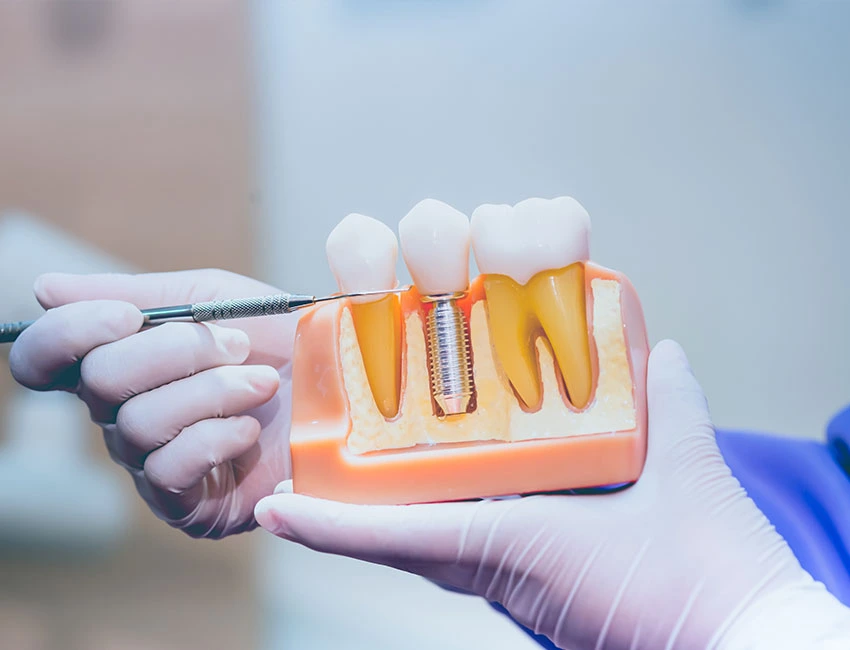 Dental Implants at The Smile Spa in Agoura Hills, CA — Dentures vs. Implants: Which Is the Better Long-Term Choice?