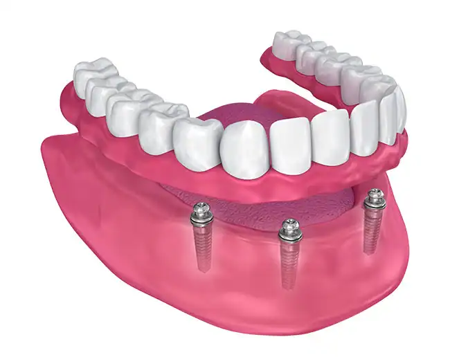 Implant-Supported Dentures / Overdentures