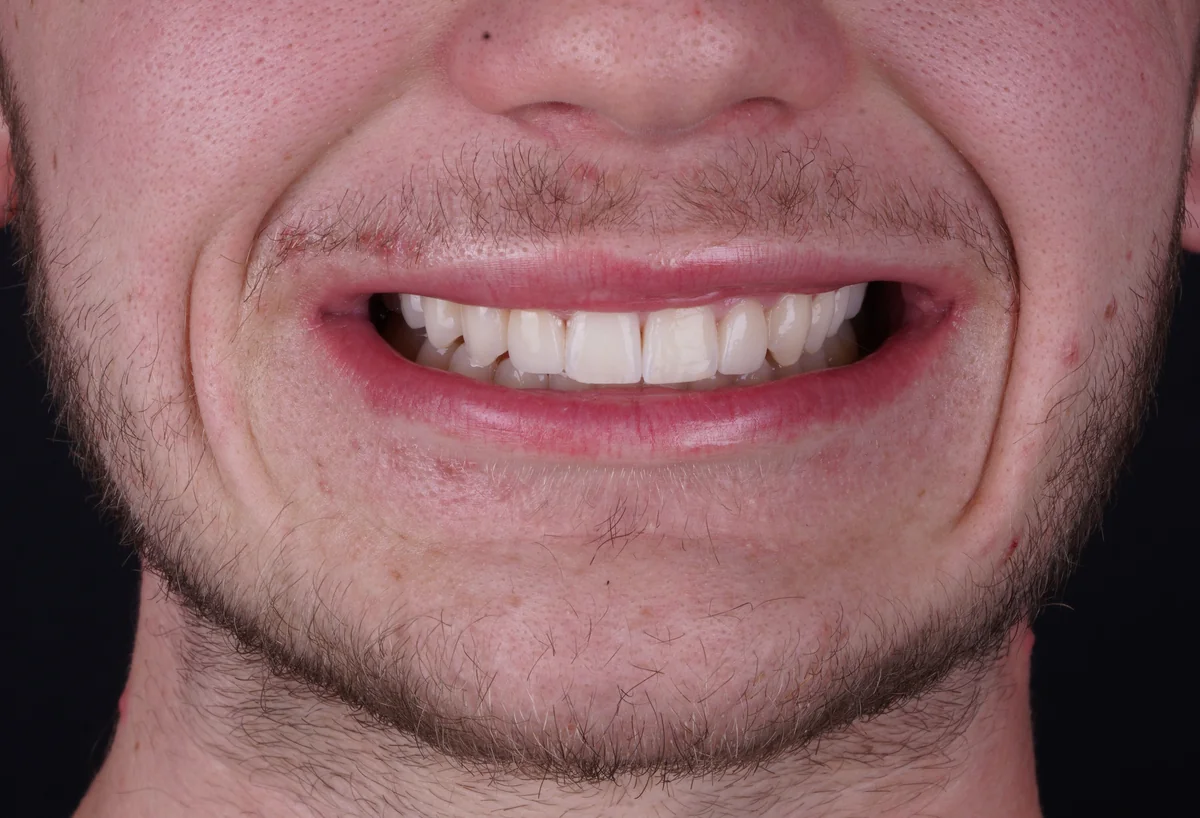 Invisalign® patient after treatment at The Smile Spa
