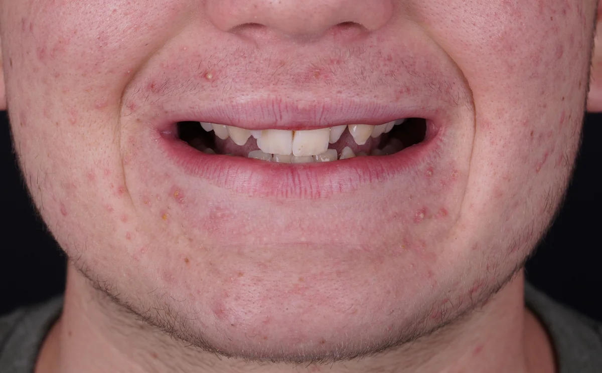 Invisalign® patient before treatment at The Smile Spa