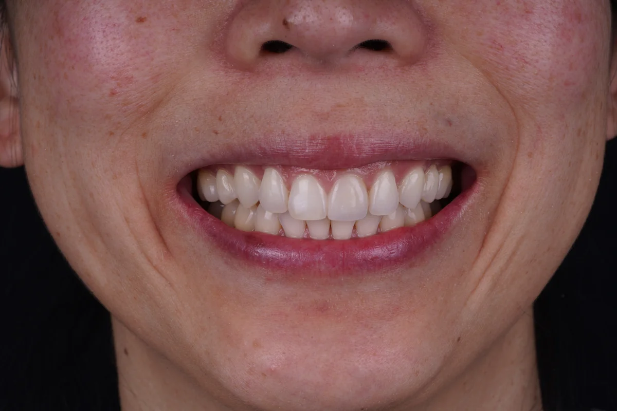 Invisalign® patient after treatment at The Smile Spa