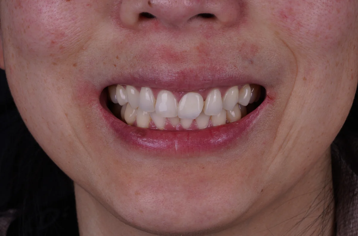 Invisalign® patient before treatment at The Smile Spa