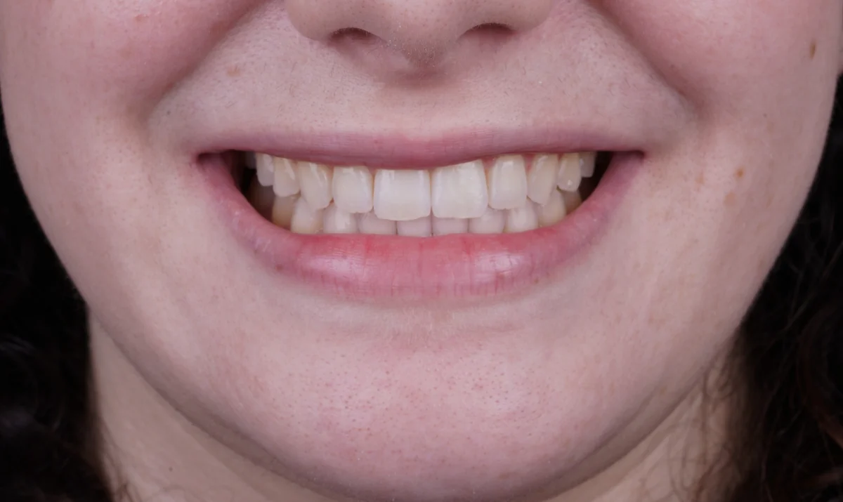 Invisalign® patient after treatment at The Smile Spa