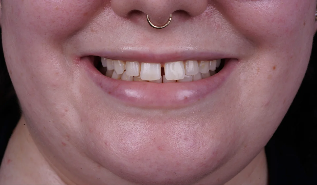 Invisalign® patient before treatment at The Smile Spa