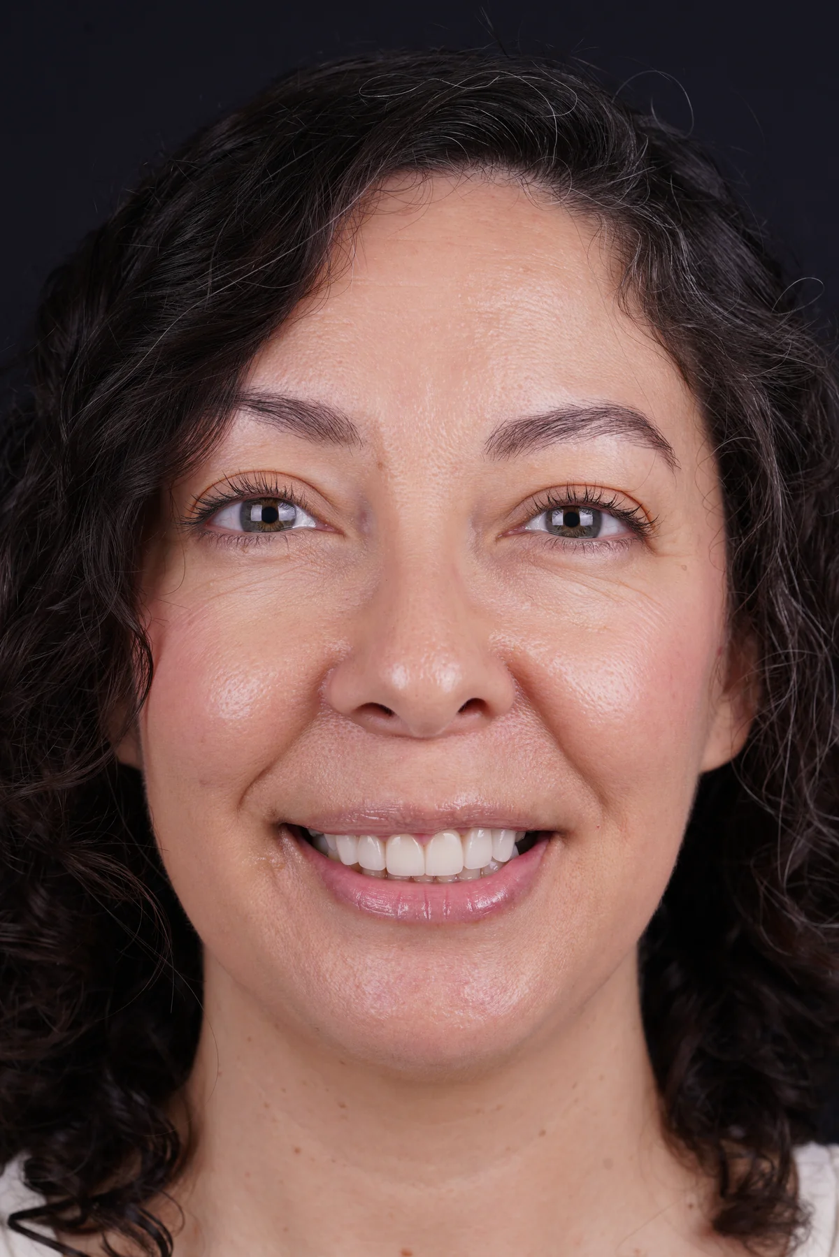 Invisalign® patient after treatment at The Smile Spa