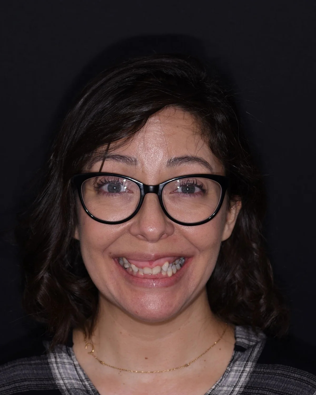 Invisalign® patient before treatment at The Smile Spa
