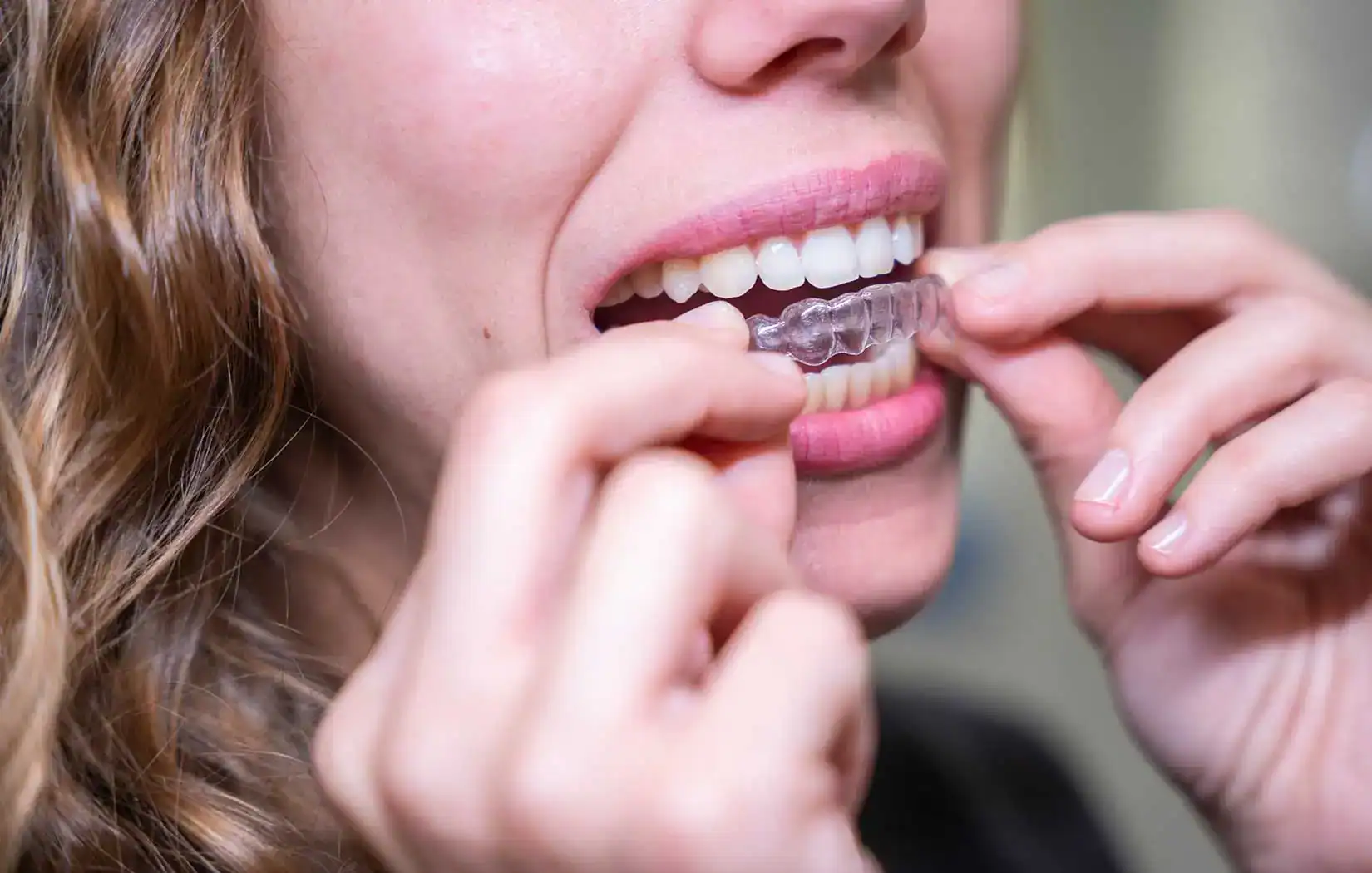 Clear Aligners at The Smile Spa in Agoura Hills, CA — Begin 2026 With a Straighter Smile: Invisalign Clear Aligners