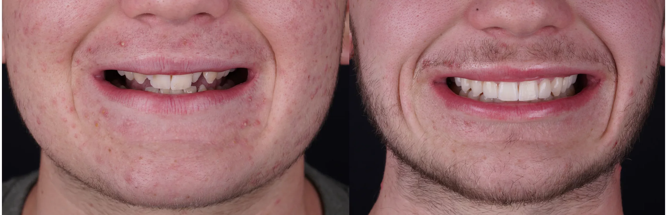Invisalign clear aligners before and after at The Smile Spa — case 1