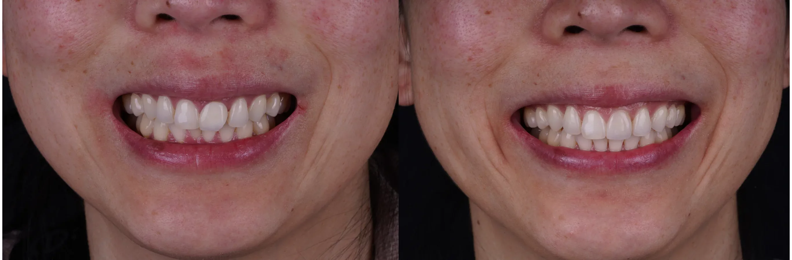 Invisalign clear aligners before and after at The Smile Spa — case 2