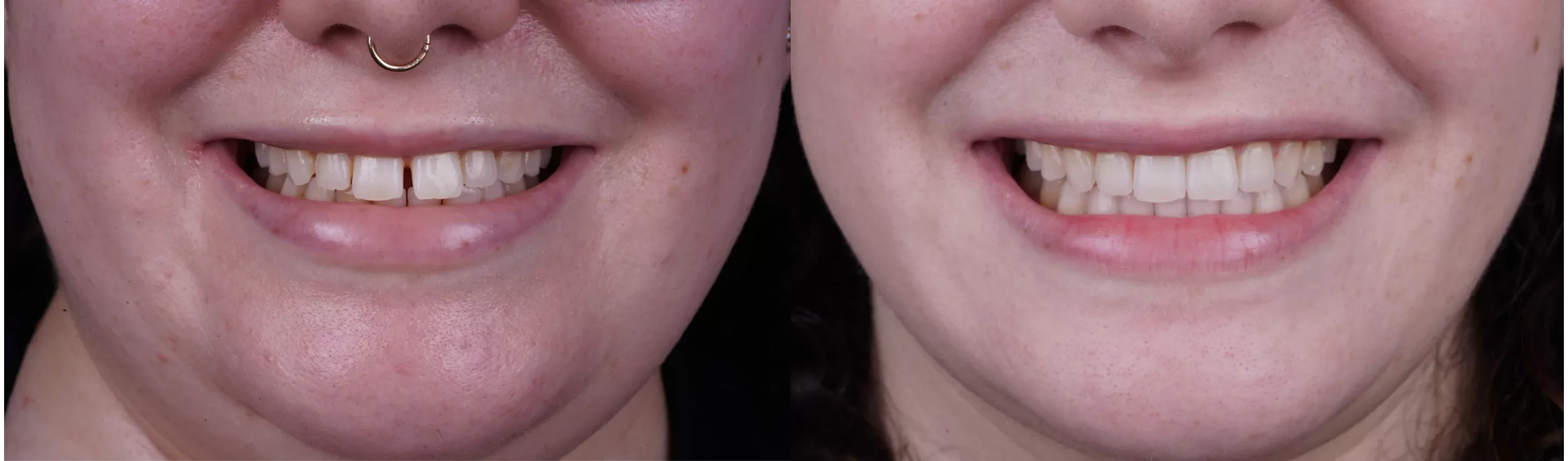 Invisalign clear aligners before and after at The Smile Spa — case 3