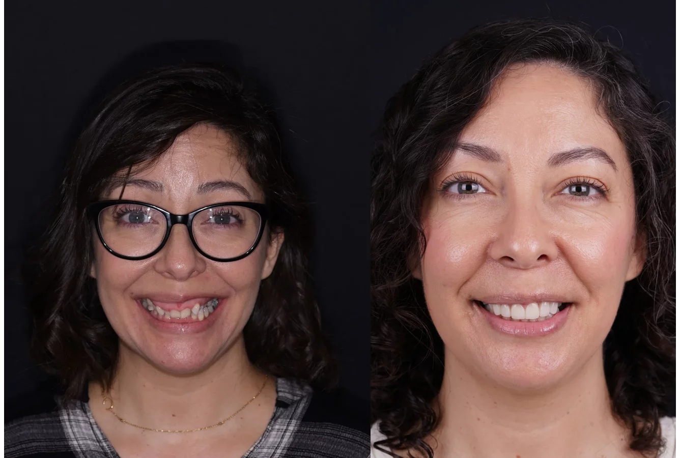 Invisalign clear aligners before and after at The Smile Spa — case 4