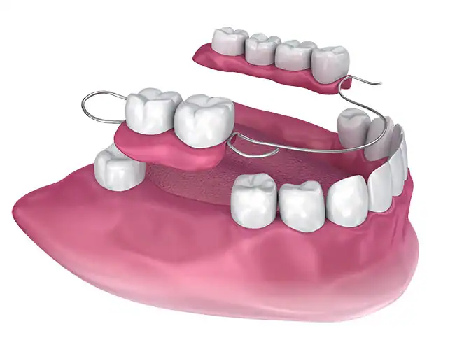 Dentures and Partial Dentures at The Smile Spa in Agoura Hills, CA — What Should I Do If I Lose a Denture?