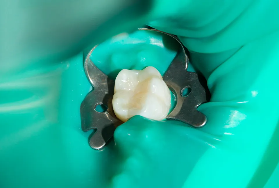 Root Canal Treatment in Agoura Hills, CA