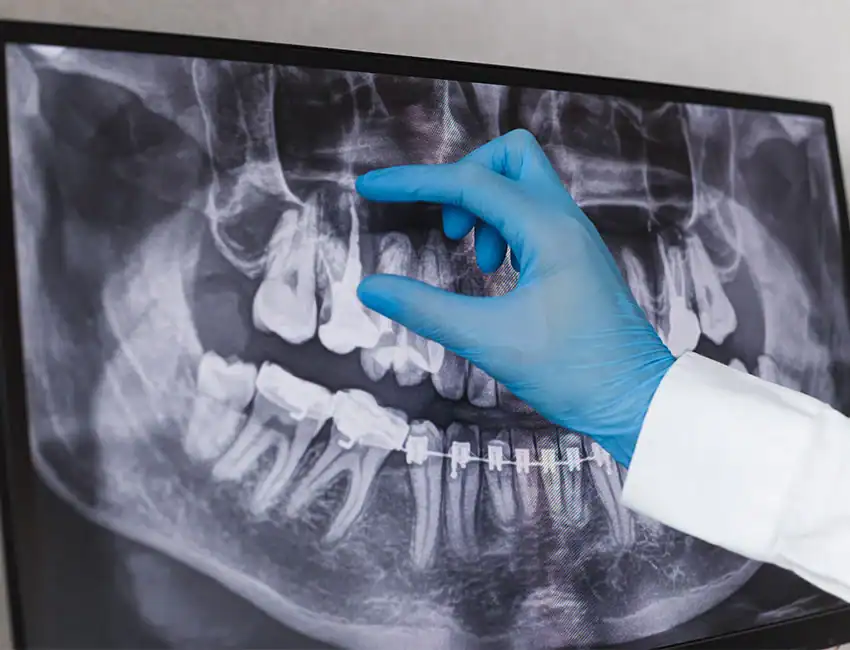 Root Canal Treatment at The Smile Spa