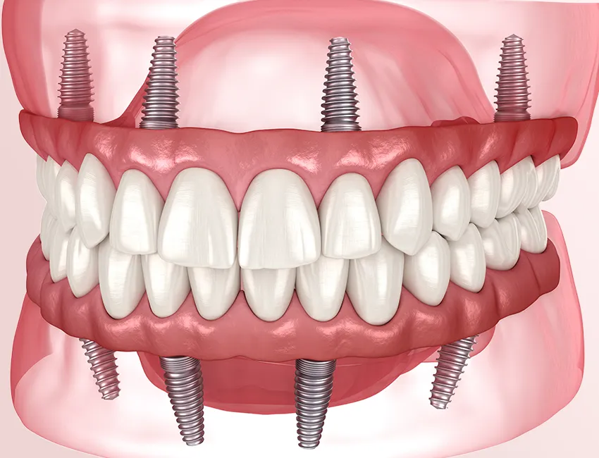 All-on-4 Dental Implants at The Smile Spa in Agoura Hills, CA — All-on-4 Treatment from Your Dentist