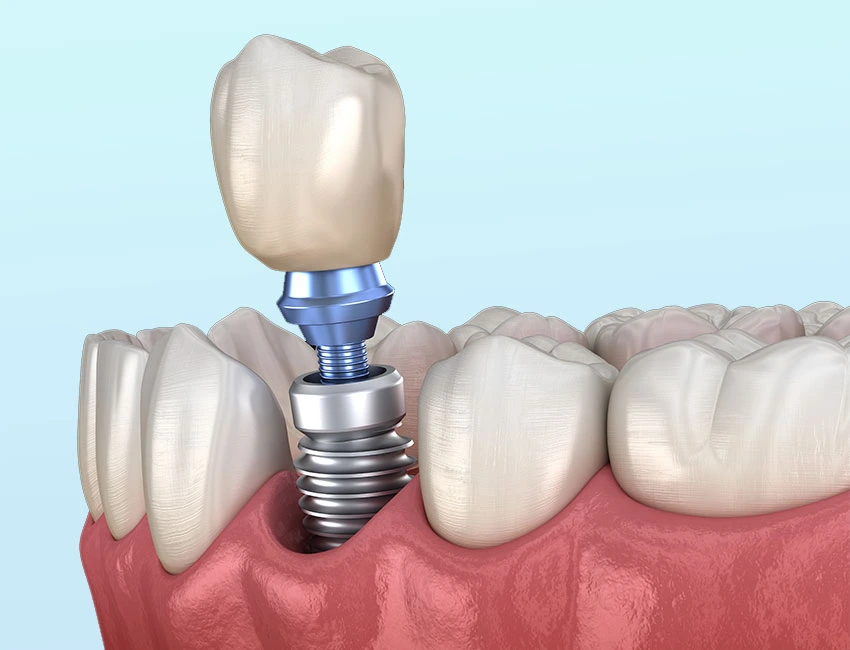 Dental Implants at The Smile Spa in Agoura Hills, CA — What Happens to the Bone in Your Jaw During the Months After an Implant?